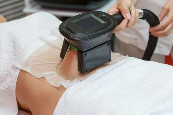 Image of person having fat freezing treatment to help weight gain Stoulton