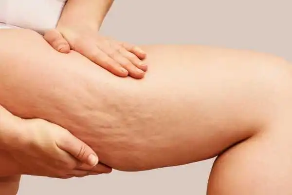 Image of woman showing leg with cellulite Stoulton