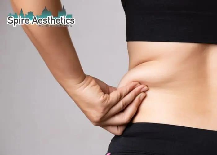 Image of woman pinching fat on their hips Stoulton. Fat Freezing treatment