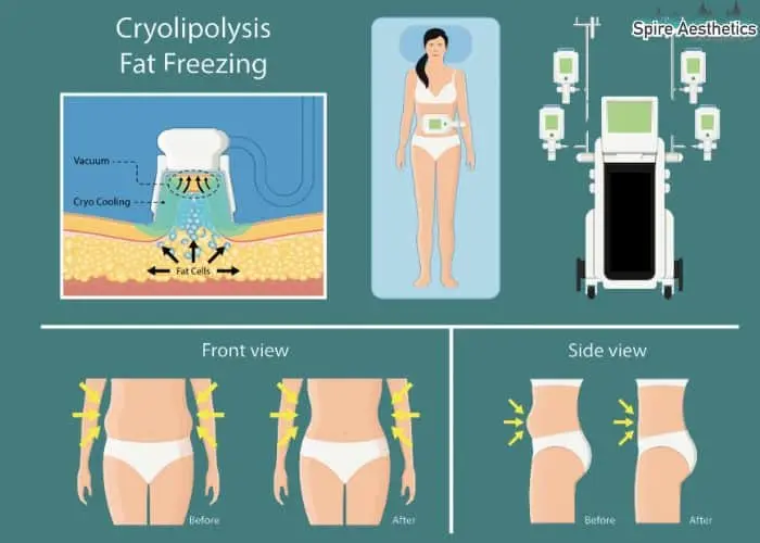 Fat freezing treatment Stoulton benefits for competitions to remove stubborn fat deposits.