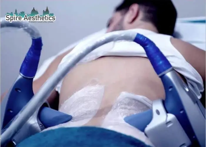 Man having fat freezing treatment done on love handles before a competitions Stoulton to create a sculpted look.