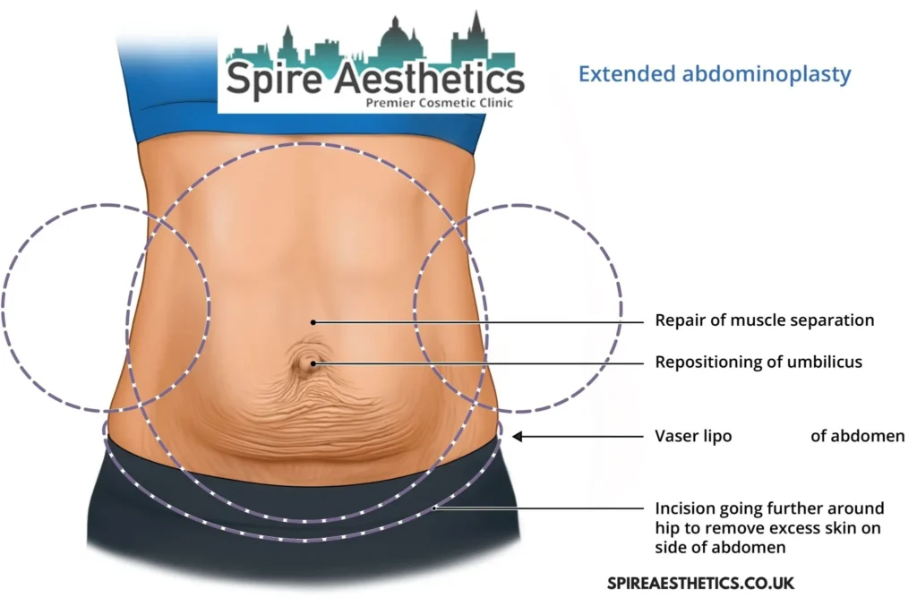 Understanding Loose Skin After Gastric Band Stoulton Surgery and HIFU Treatment