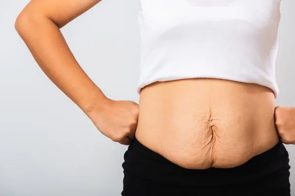 Image of a woman's stomach after weight loss with sagging skin following a gastric band Stoulton