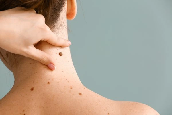 skin blemish removal Stoulton treatment