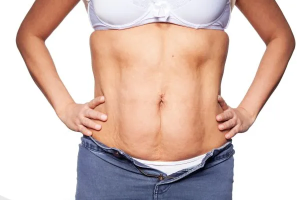 sagging skin on woman's stomach after weight loss injections Stoulton