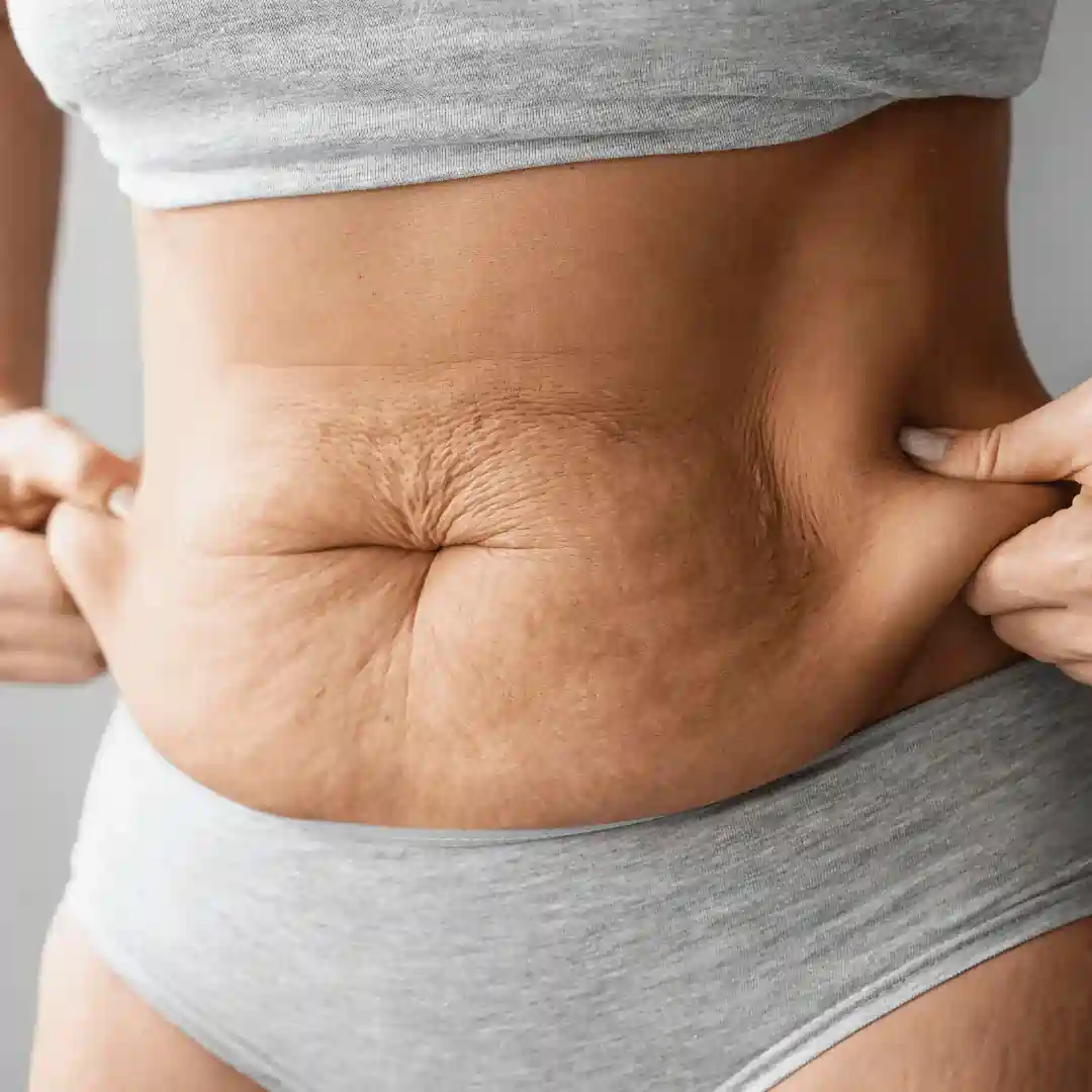 Is It Normal to Have Loose Skin After Pregnancy Stoulton?